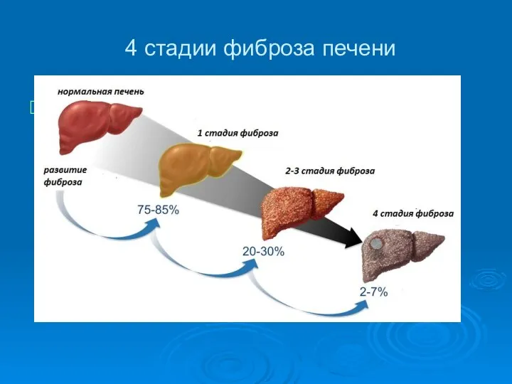 4 стадии фиброза печени ррр