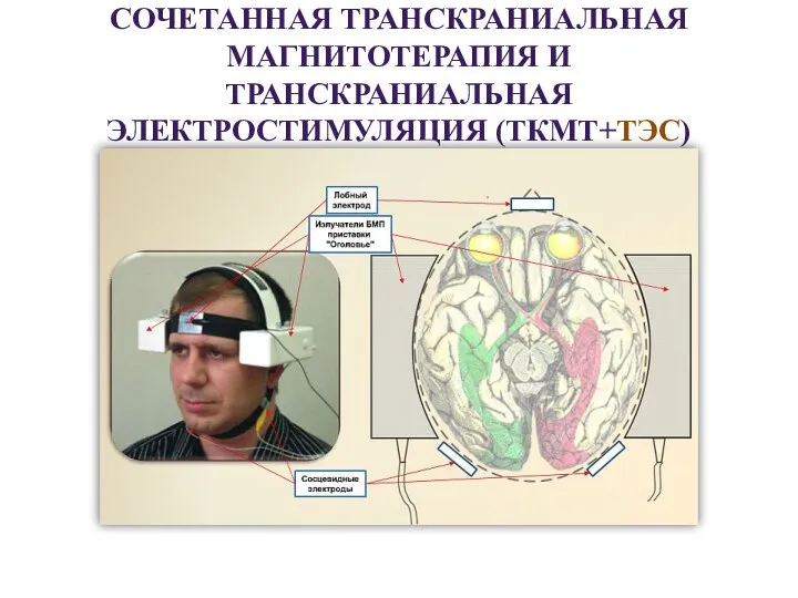 СОЧЕТАННАЯ ТРАНСКРАНИАЛЬНАЯ МАГНИТОТЕРАПИЯ И ТРАНСКРАНИАЛЬНАЯ ЭЛЕКТРОСТИМУЛЯЦИЯ (ТКМТ+ТЭС)