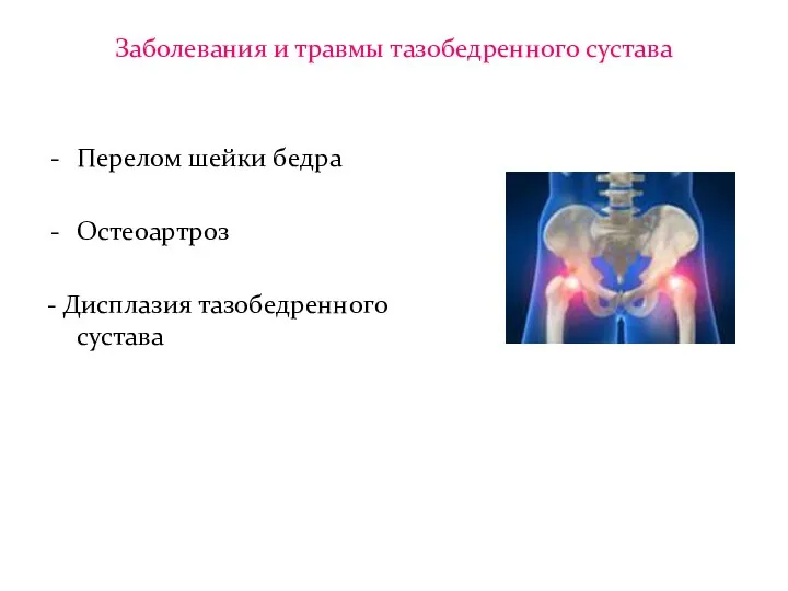 Заболевания и травмы тазобедренного сустава Перелом шейки бедра Остеоартроз - Дисплазия тазобедренного сустава