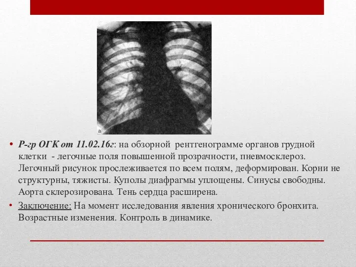 Р-гр ОГК от 11.02.16г: на обзорной рентгенограмме органов грудной клетки - легочные