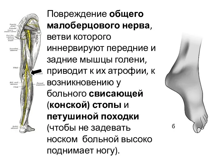 Повреждение общего малоберцового нерва, ветви которого иннервируют передние и задние мышцы голени,