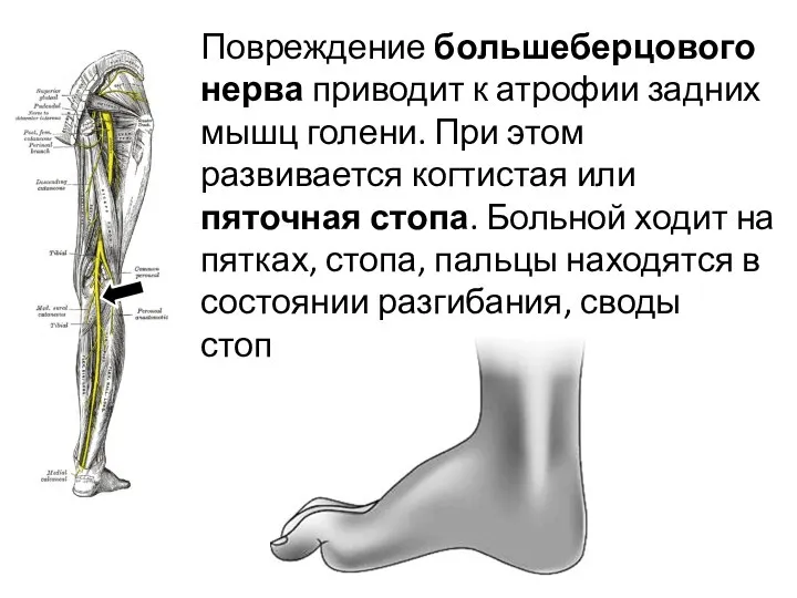 Повреждение большеберцового нерва приводит к атрофии задних мышц голени. При этом развивается