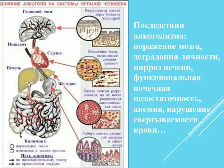 Последствия алкоголизма: поражение мозга, деградация личности, цирроз печени, функциональная почечная недостаточность, анемия, нарушение свертываемости крови…