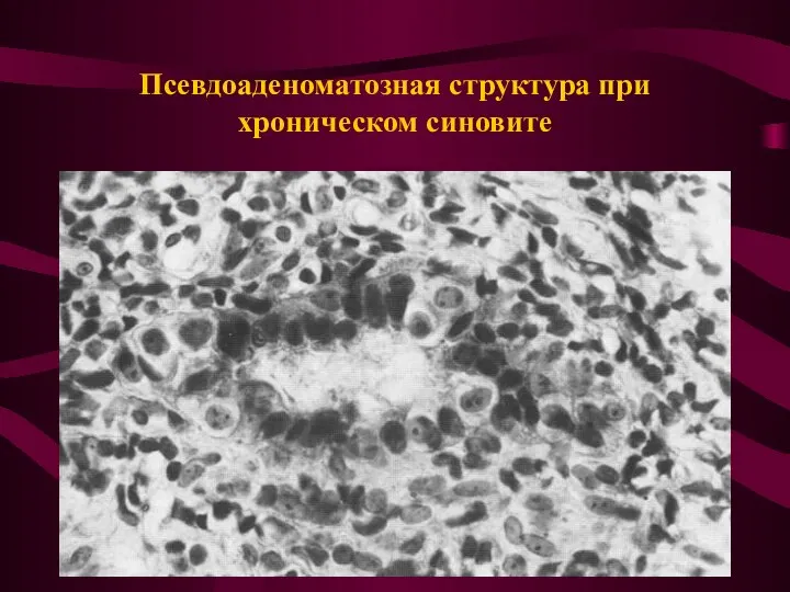 Псевдоаденоматозная структура при хроническом синовите