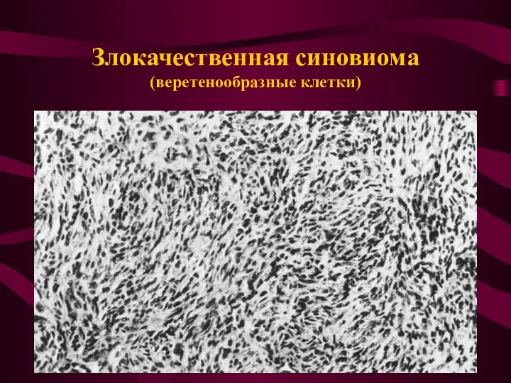 Злокачественная синовиома (веретенообразные клетки)