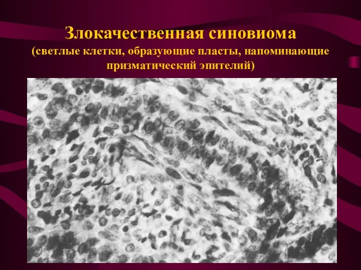 Злокачественная синовиома (светлые клетки, образующие пласты, напоминающие призматический эпителий)