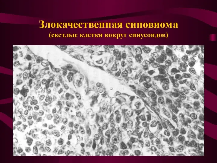 Злокачественная синовиома (светлые клетки вокруг синусоидов)