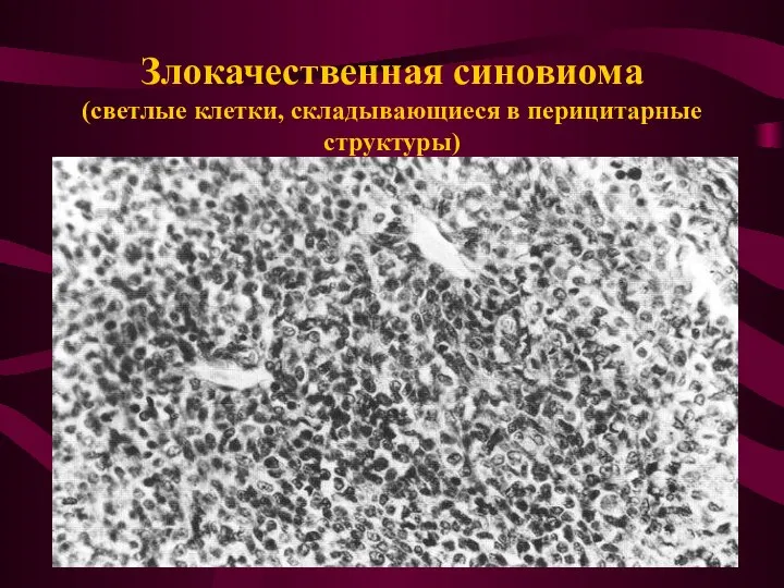 Злокачественная синовиома (светлые клетки, складывающиеся в перицитарные структуры)