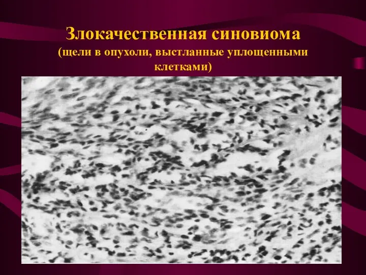 Злокачественная синовиома (щели в опухоли, выстланные уплощенными клетками)