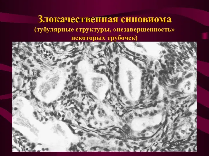 Злокачественная синовиома (тубулярные структуры, «незавершенность» некоторых трубочек)