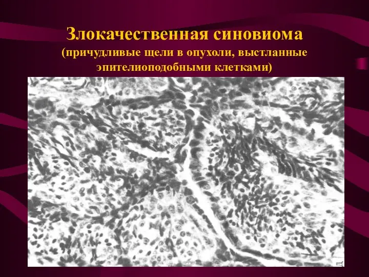 Злокачественная синовиома (причудливые щели в опухоли, выстланные эпителиоподобными клетками)