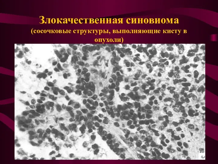 Злокачественная синовиома (сосочковые структуры, выполняющие кисту в опухоли)