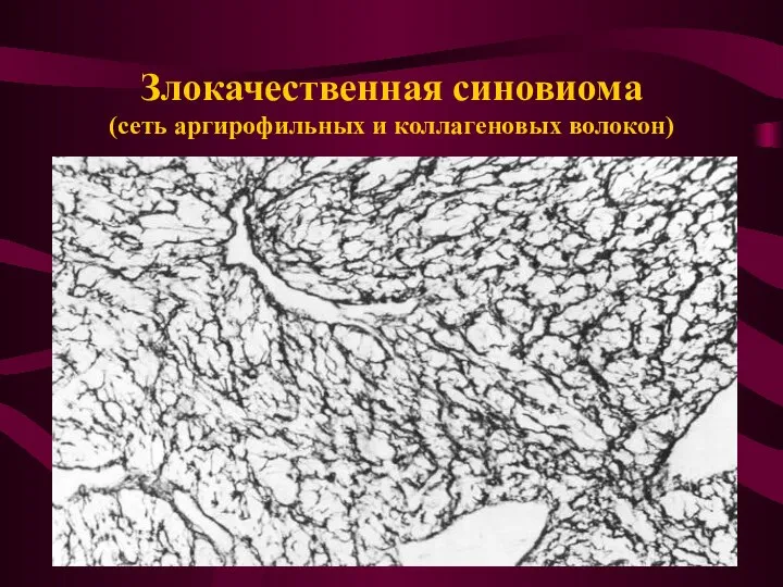 Злокачественная синовиома (сеть аргирофильных и коллагеновых волокон)