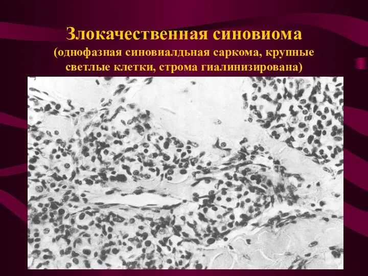 Злокачественная синовиома (однофазная синовиалдьная саркома, крупные светлые клетки, строма гиалинизирована)