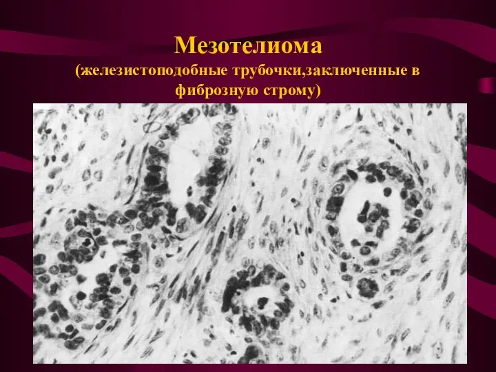 Мезотелиома (железистоподобные трубочки,заключенные в фиброзную строму)