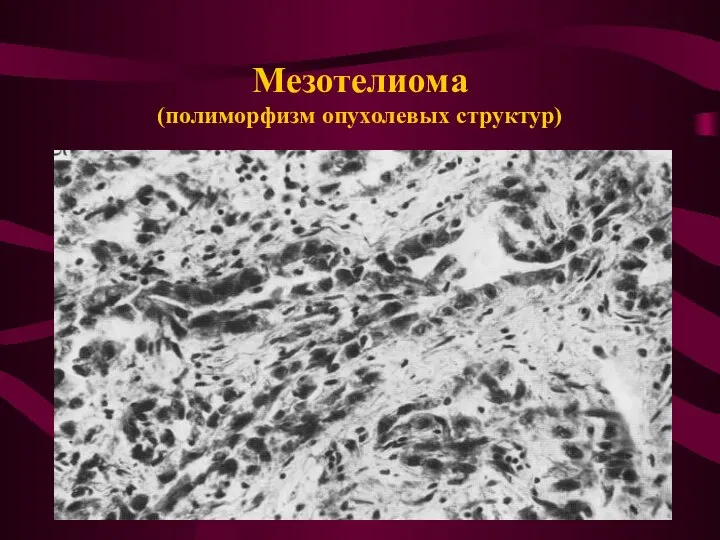 Мезотелиома (полиморфизм опухолевых структур)