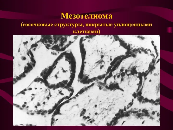 Мезотелиома (сосочковые структуры, покрытые уплощенными клетками)