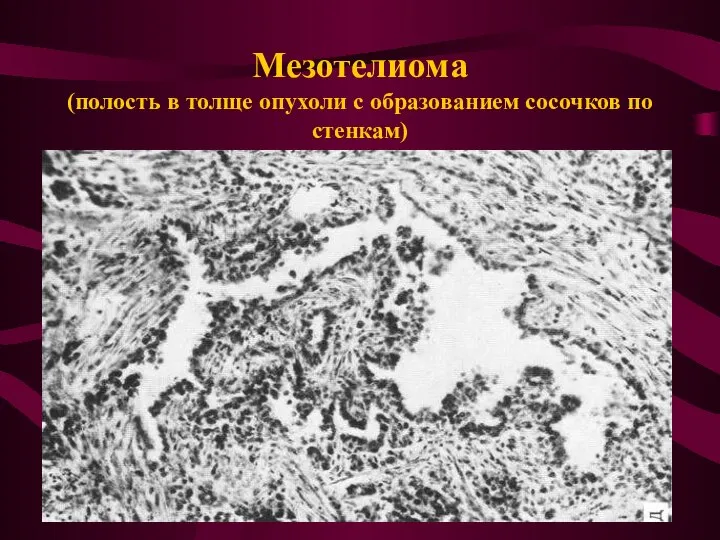 Мезотелиома (полость в толще опухоли с образованием сосочков по стенкам)