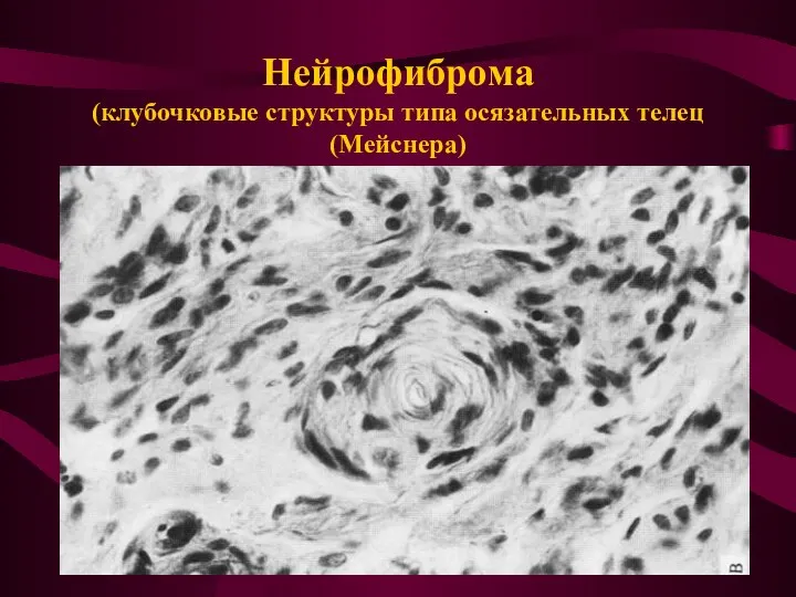 Нейрофиброма (клубочковые структуры типа осязательных телец (Мейснера)