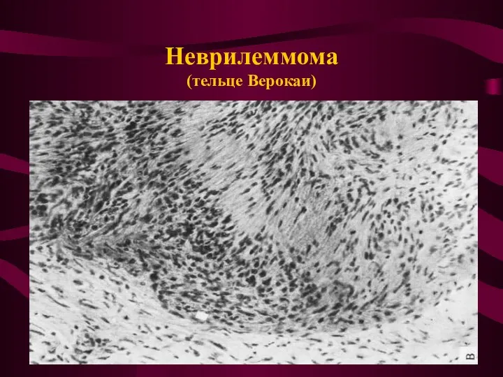 Неврилеммома (тельце Верокаи)