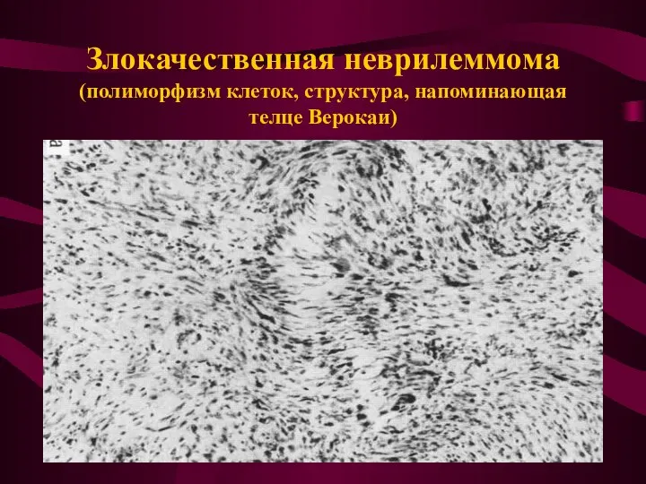 Злокачественная неврилеммома (полиморфизм клеток, структура, напоминающая телце Верокаи)