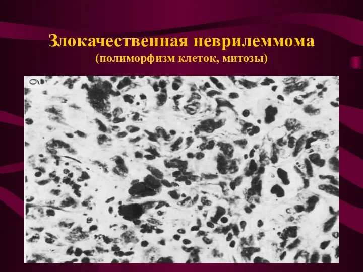 Злокачественная неврилеммома (полиморфизм клеток, митозы)