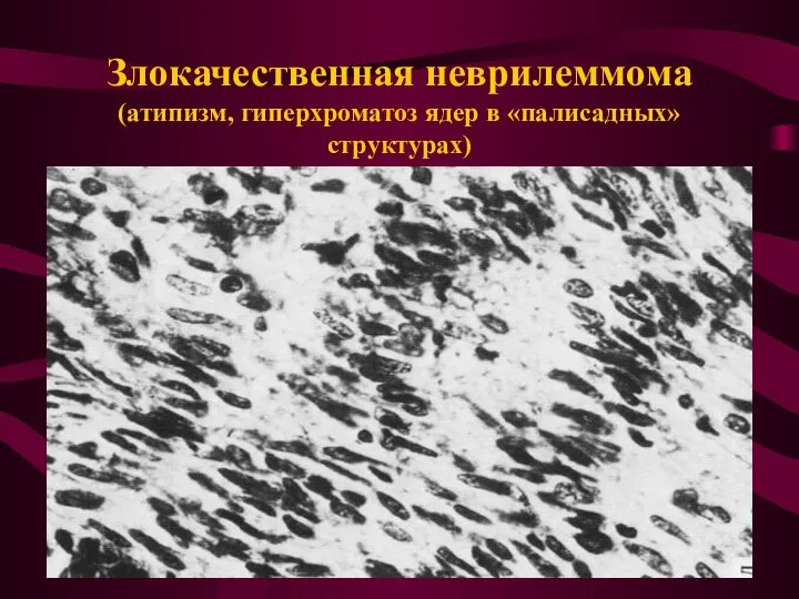 Злокачественная неврилеммома (атипизм, гиперхроматоз ядер в «палисадных» структурах)