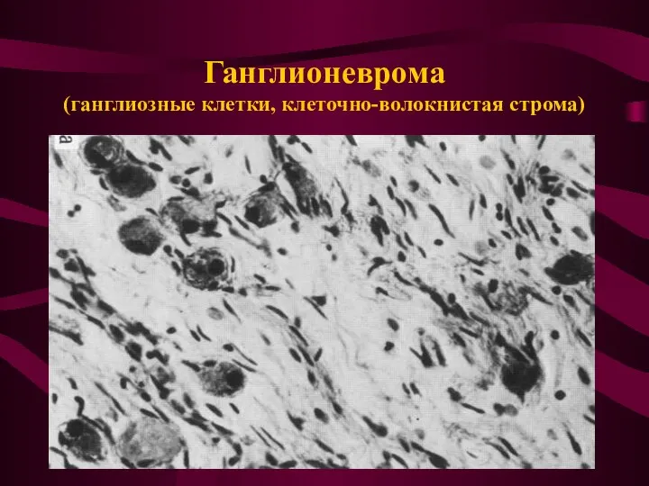 Ганглионеврома (ганглиозные клетки, клеточно-волокнистая строма)