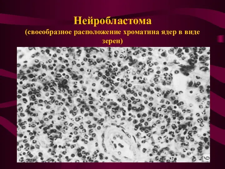Нейробластома (своеобразное расположение хроматина ядер в виде зерен)