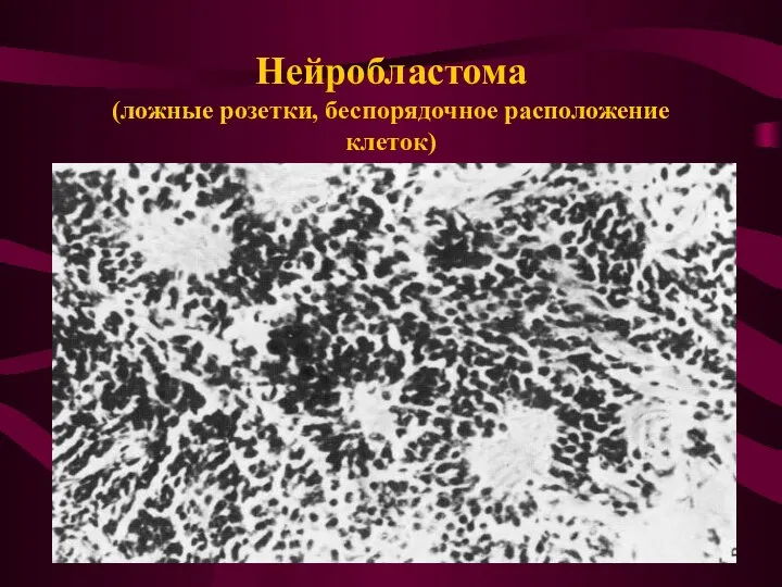Нейробластома (ложные розетки, беспорядочное расположение клеток)