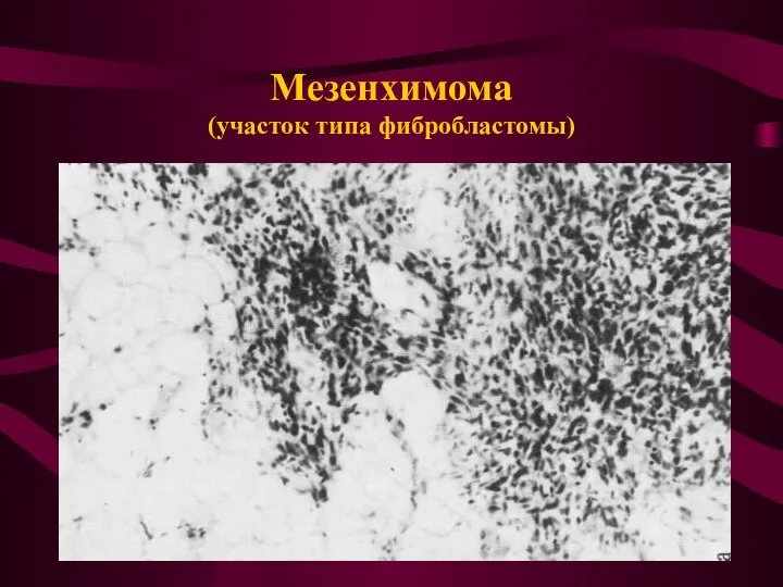 Мезенхимома (участок типа фибробластомы)