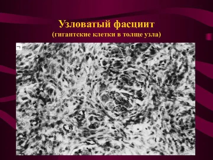 Узловатый фасциит (гигантские клетки в толще узла)