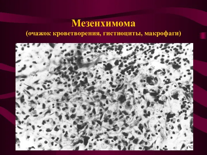 Мезенхимома (очажок кроветворения, гистиоциты, макрофаги)
