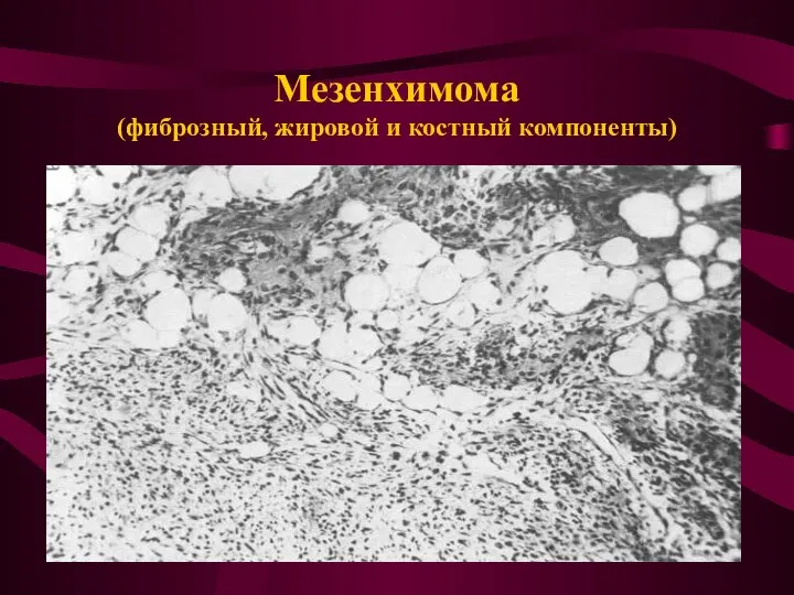 Мезенхимома (фиброзный, жировой и костный компоненты)