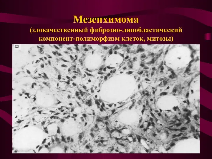 Мезенхимома (злокачественный фиброзно-липобластический компонент-полиморфизм клеток, митозы)