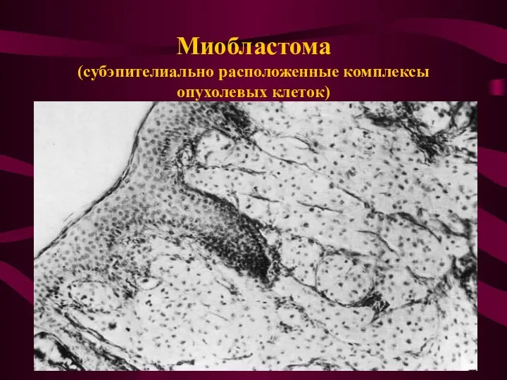 Миобластома (субэпителиально расположенные комплексы опухолевых клеток)