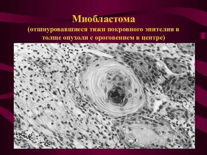 Миобластома (отшнуровавшиеся тяжи покровного эпителия в толще опухоли с ороговением в центре)