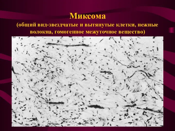 Миксома (общий вид-звездчатые и вытянутые клетки, нежные волокна, гомогенное межуточное вещество)