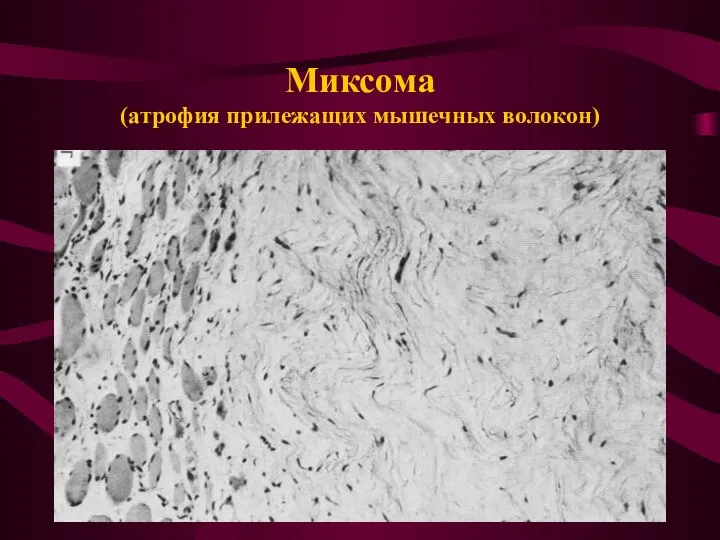 Миксома (атрофия прилежащих мышечных волокон)