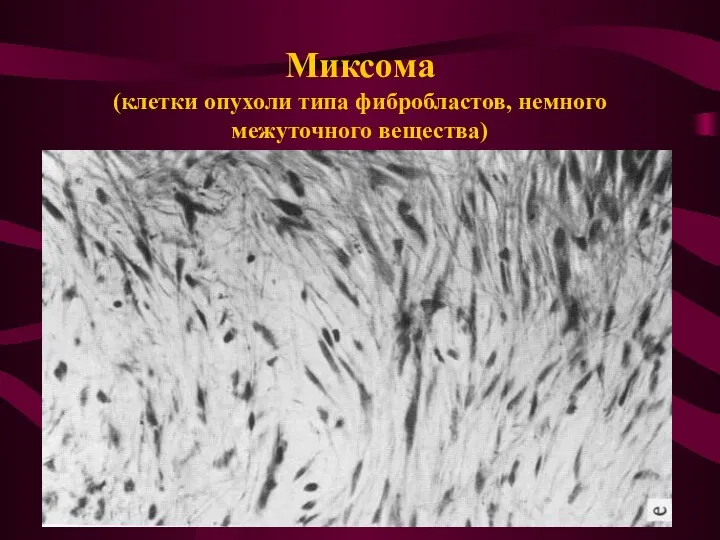 Миксома (клетки опухоли типа фибробластов, немного межуточного вещества)