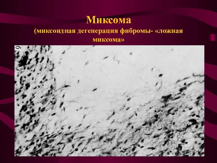 Миксома (миксоидная дегенерация фибромы- «ложная миксома»