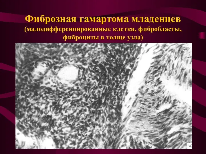 Фиброзная гамартома младенцев (малодифференцированные клетки, фибробласты, фиброциты в толще узла)