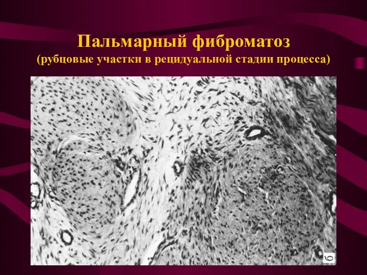 Пальмарный фиброматоз (рубцовые участки в рецидуальной стадии процесса)