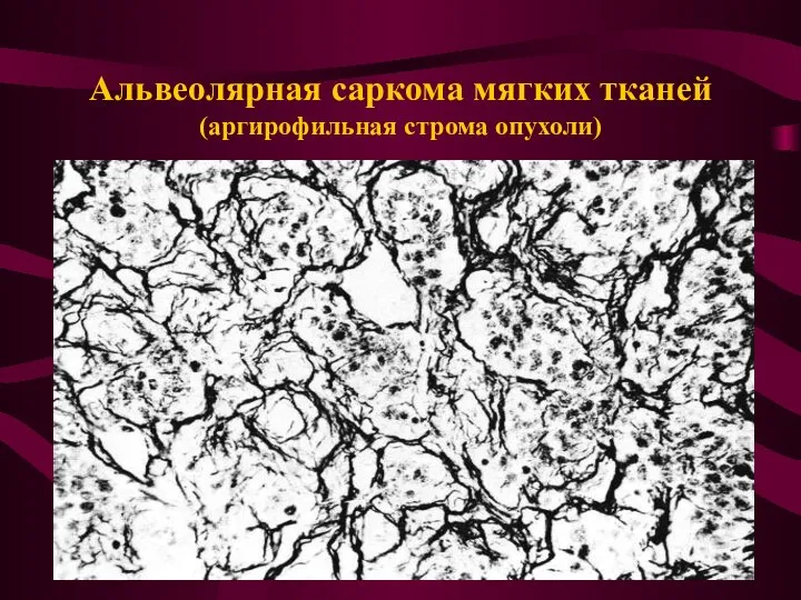 Альвеолярная саркома мягких тканей (аргирофильная строма опухоли)