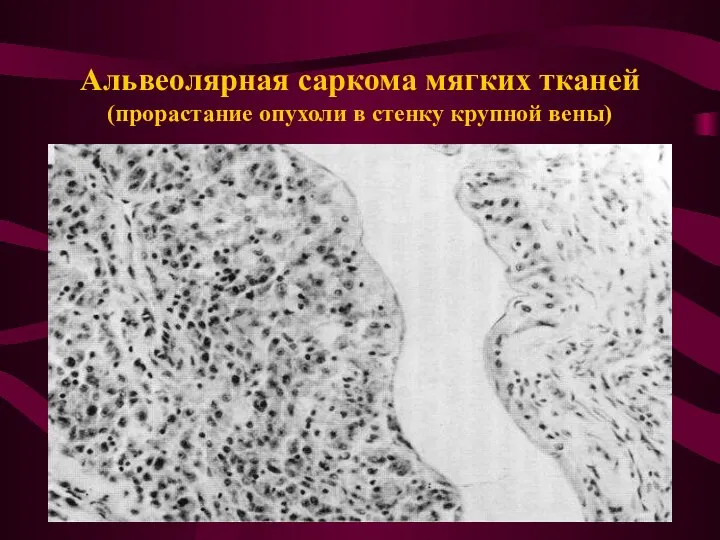 Альвеолярная саркома мягких тканей (прорастание опухоли в стенку крупной вены)