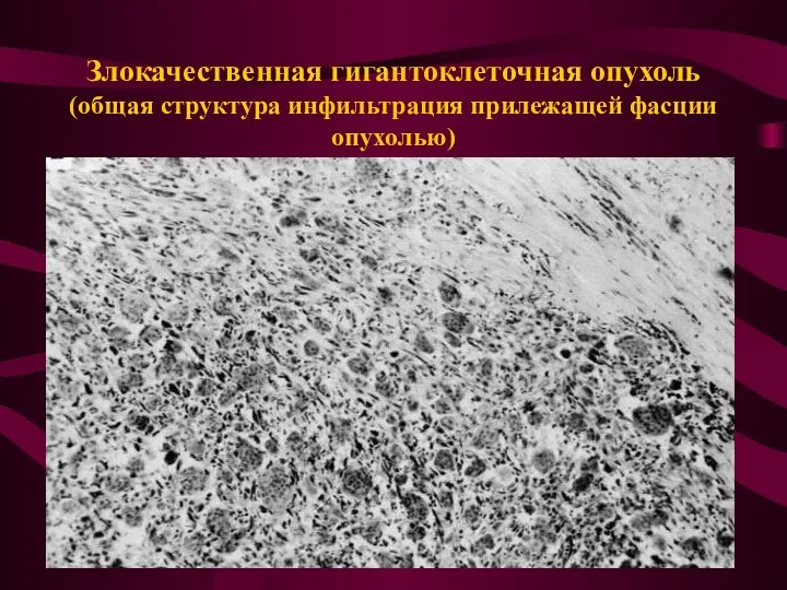 Злокачественная гигантоклеточная опухоль (общая структура инфильтрация прилежащей фасции опухолью)