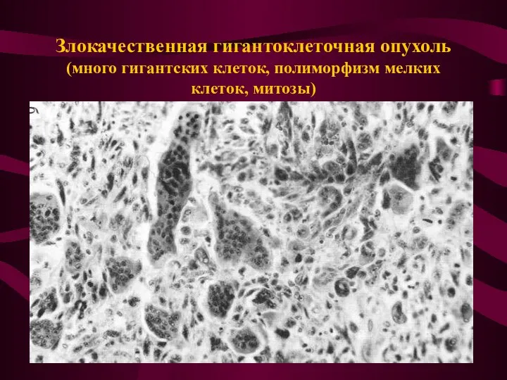 Злокачественная гигантоклеточная опухоль (много гигантских клеток, полиморфизм мелких клеток, митозы)