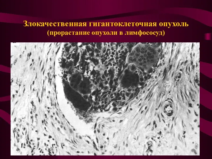 Злокачественная гигантоклеточная опухоль (прорастание опухоли в лимфососуд)