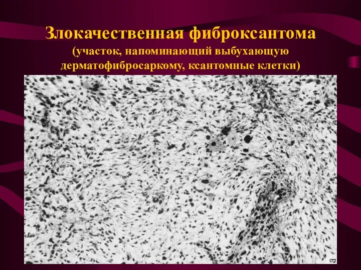 Злокачественная фиброксантома (участок, напоминающий выбухающую дерматофибросаркому, ксантомные клетки)