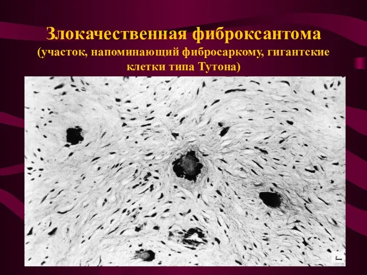 Злокачественная фиброксантома (участок, напоминающий фибросаркому, гигантские клетки типа Тутона)